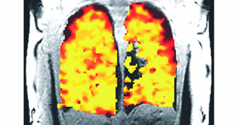 Scan showing where air is taken in the lungs coloured red and yellow where